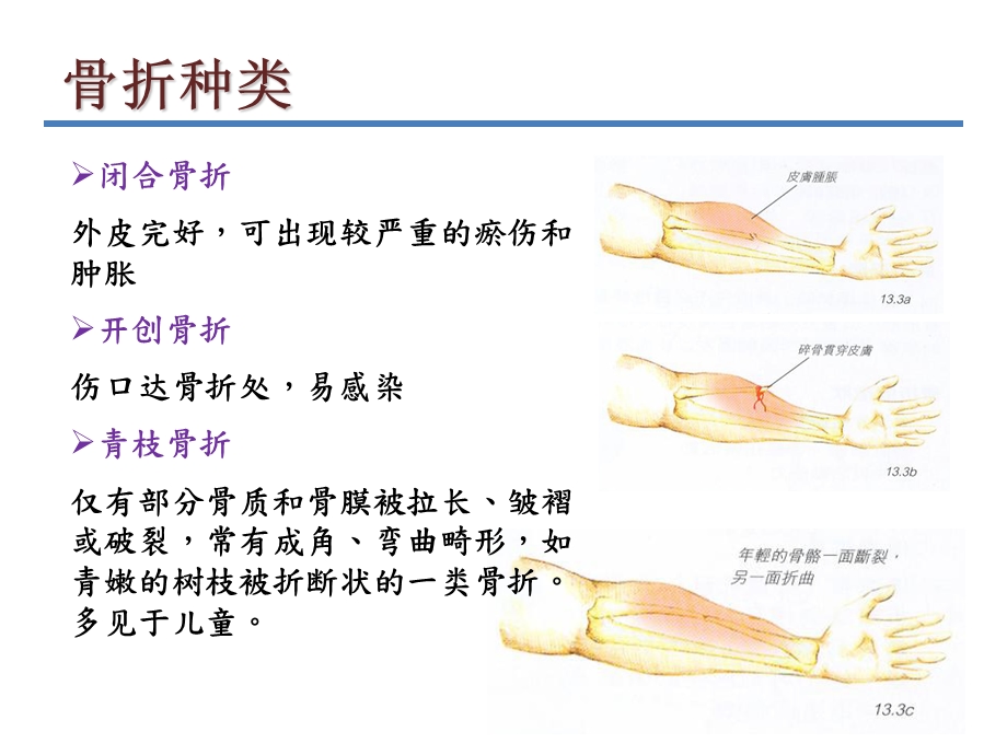 急救-骨折的急救处理与搬运.ppt_第3页