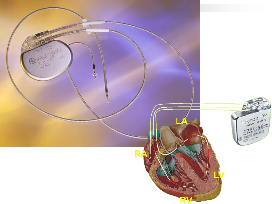 心脏起搏器ppt-图文.ppt_第2页