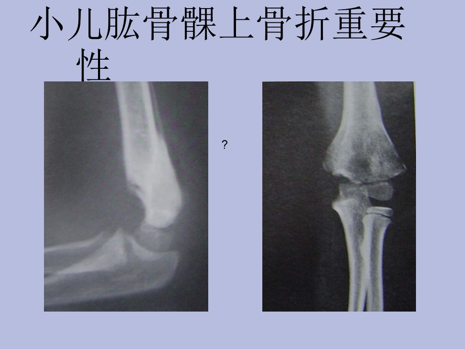 小儿肱骨髁上骨折.ppt_第2页