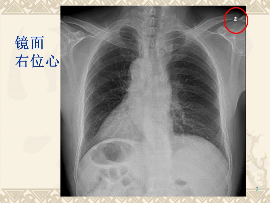 循环系统先天性病变3先心ppt课件.ppt_第3页