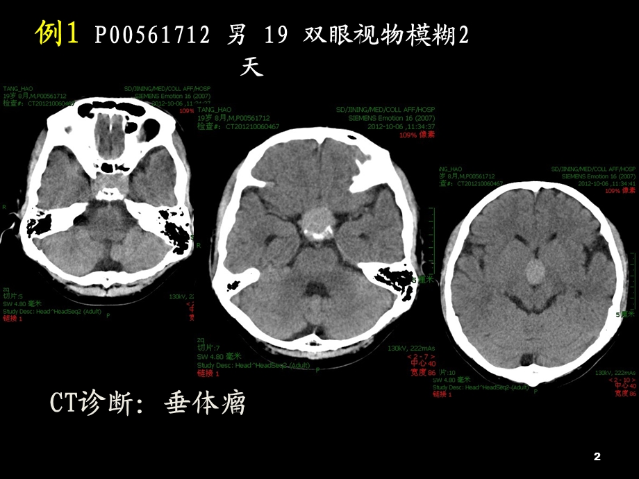 颅底少见占位性病变.ppt_第2页