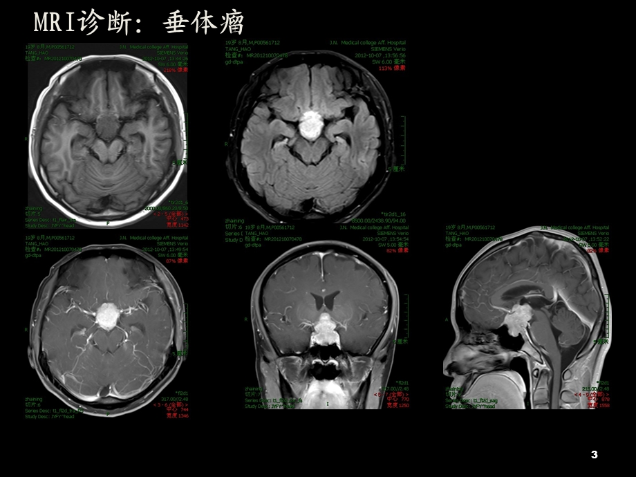 颅底少见占位性病变.ppt_第3页