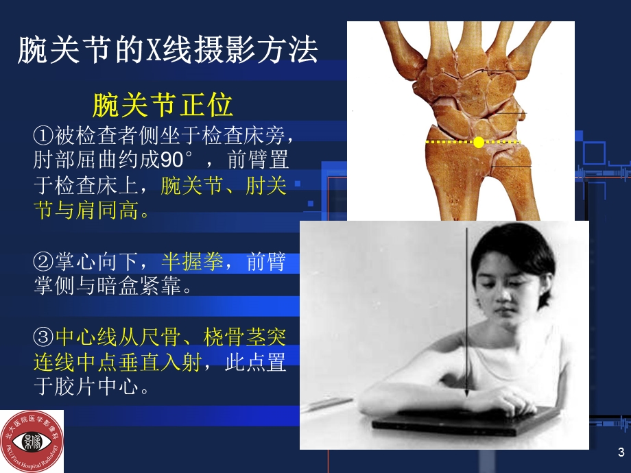 腕关节常见骨折与摄影方法.ppt_第3页