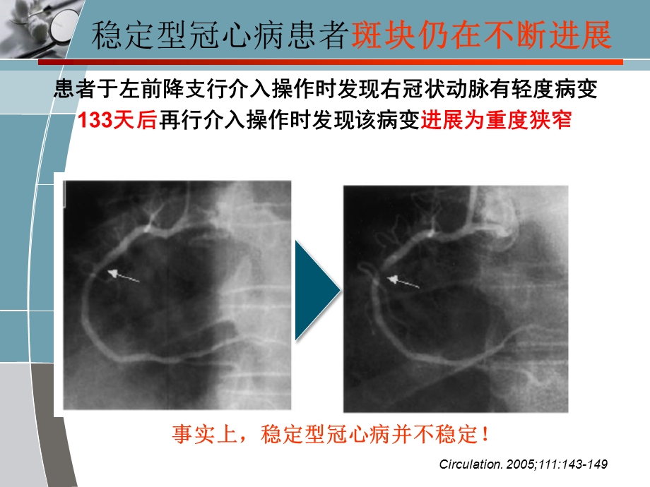 稳定型心绞痛的治疗策略优化药物治疗OR血运重建治疗.ppt_第3页