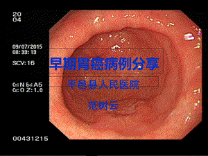 早期胃癌病例分享.ppt