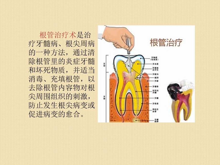 根管治疗的护理课件.ppt_第2页