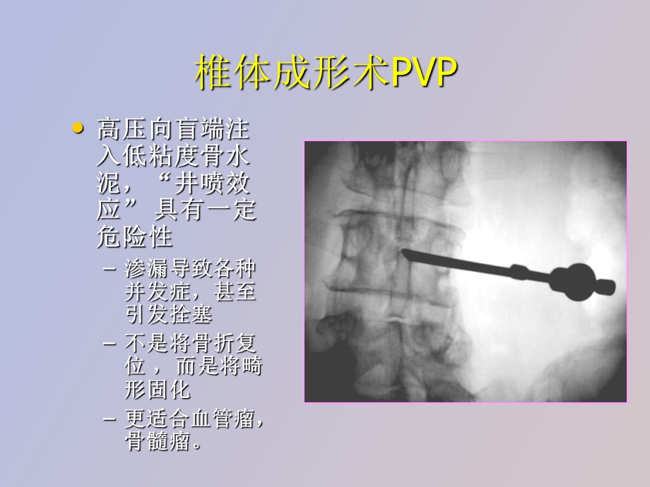 椎体成形术和kmc产品使用技巧.ppt_第3页