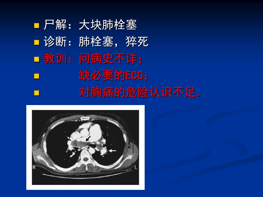 胸痛的诊断流程老问题新理念.ppt_第3页