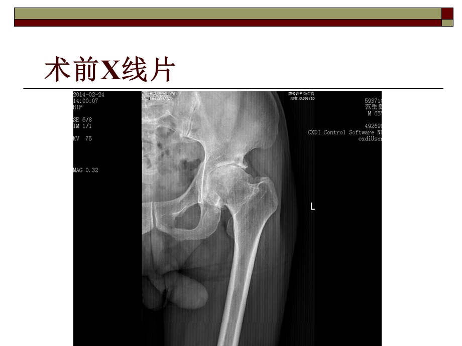 daa入路全髋关节置换术 ppt课件.ppt_第3页