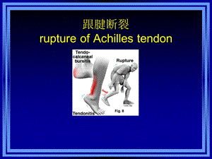 跟腱断裂.ppt