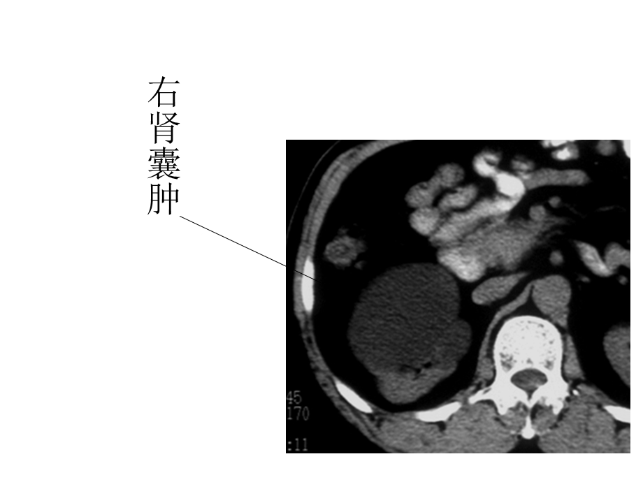 肾囊肿与多囊肾.ppt_第2页