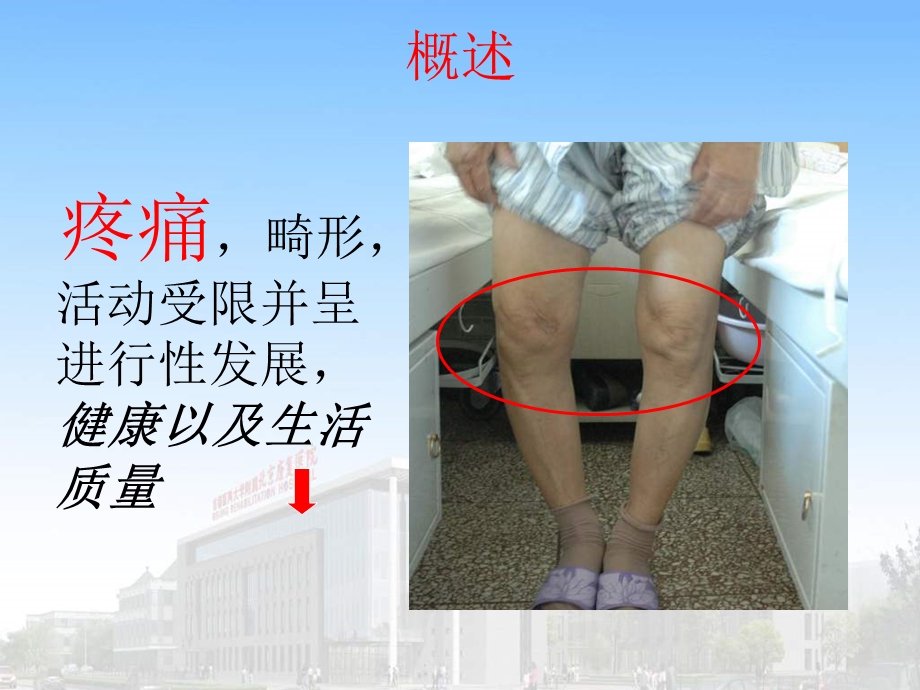 膝关单髁置换.ppt_第3页