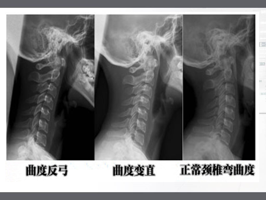 枕颌带牵引的护理.ppt_第3页