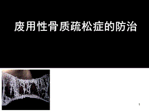 废用性骨质疏松的诊断与治疗.ppt