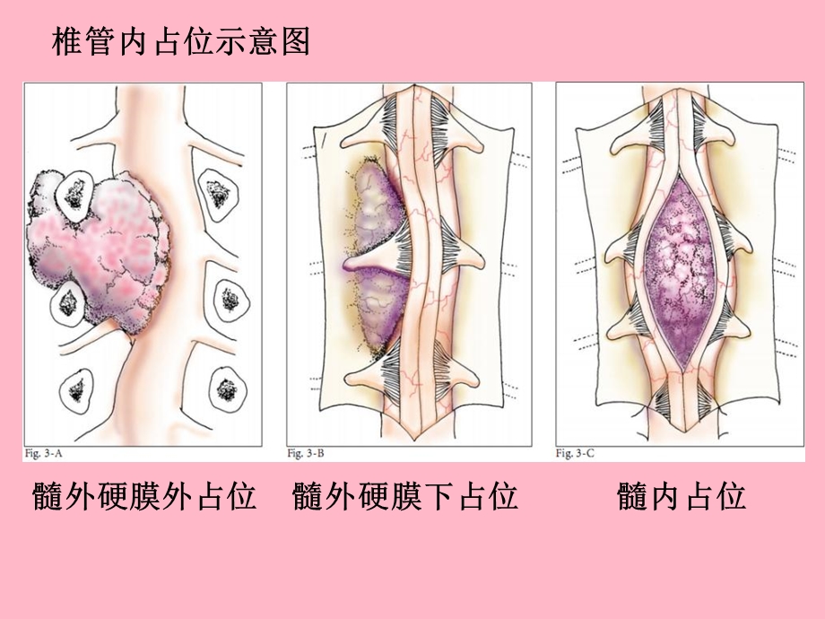 椎管肿瘤、脊柱损伤、血管畸形.ppt_第3页