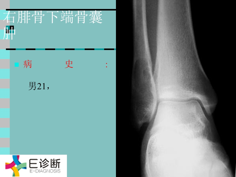 医学影像骨肿瘤X线病例图谱.ppt_第1页