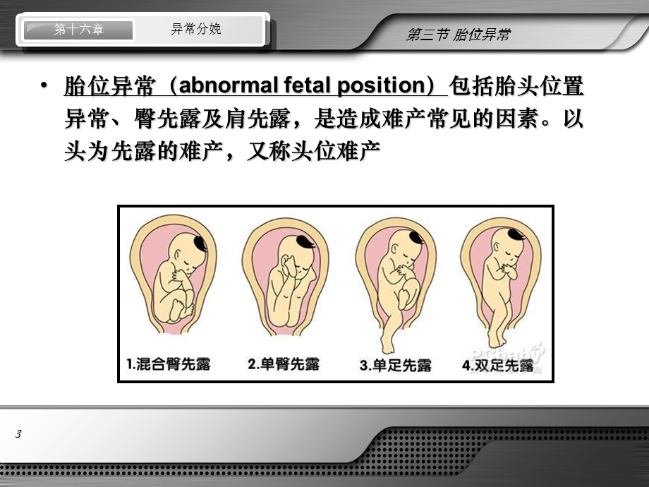 异常分娩-胎位异常.ppt_第3页