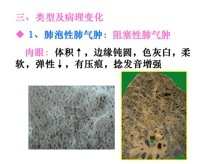 病理学慢性支气管炎、肺气肿、肺心病(下.ppt_第3页