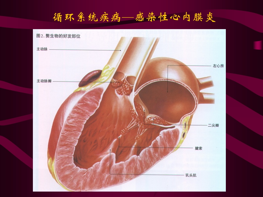 循环系统疾病—感染性心内膜炎.ppt_第3页