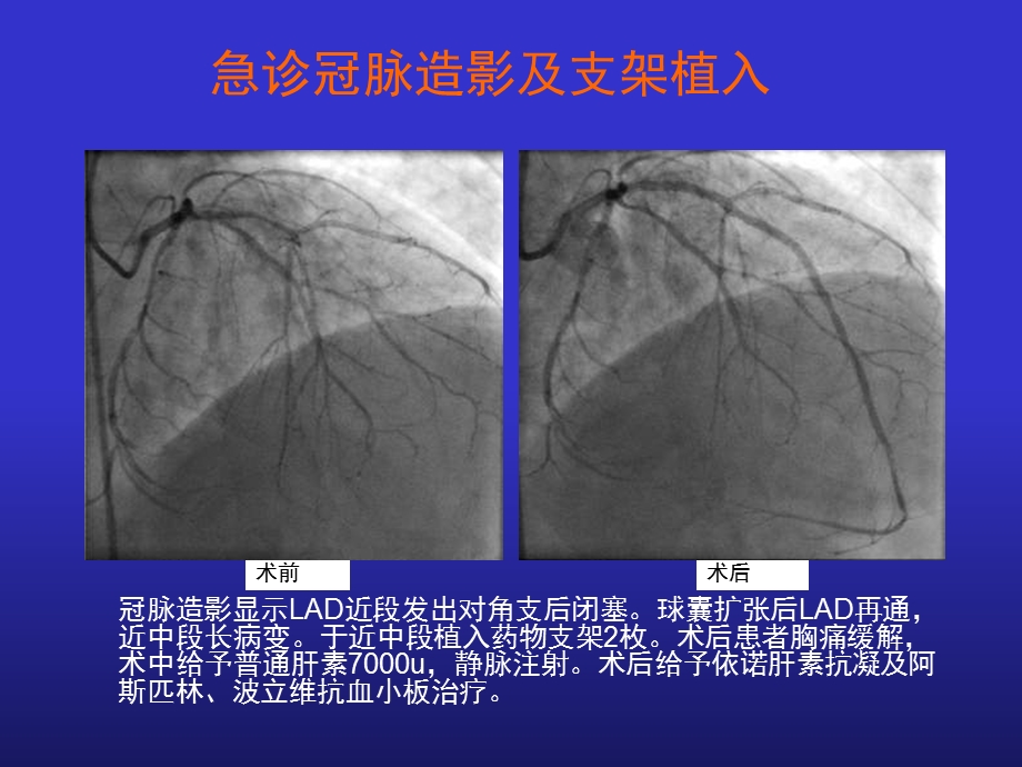 支架断裂致反复心梗的处.ppt_第3页