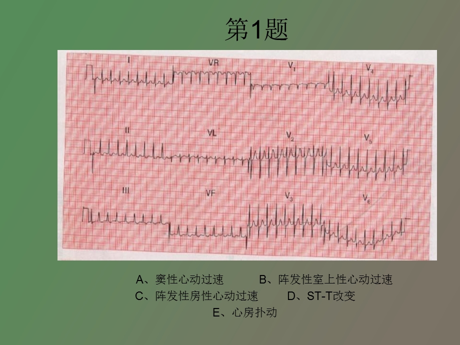 心电图考核题.ppt_第1页