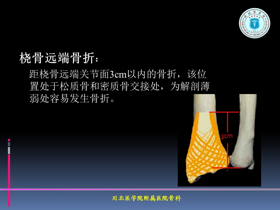 掌背侧钢板治疗桡骨远端骨折.ppt_第2页