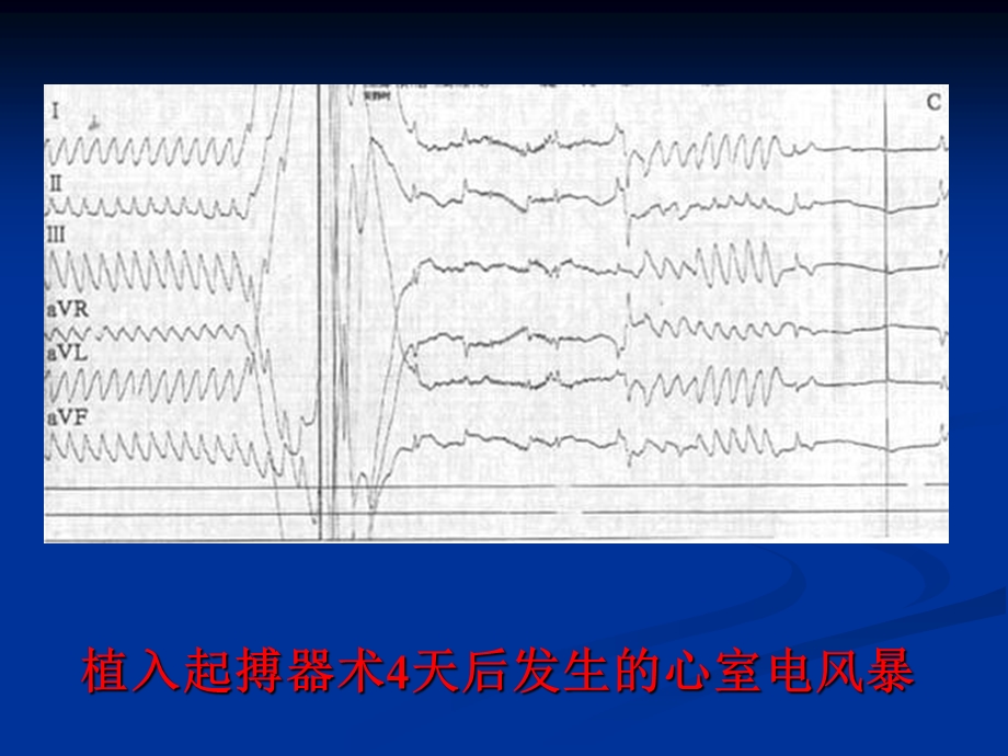 心电风暴学习HDYANGBZ.ppt_第3页