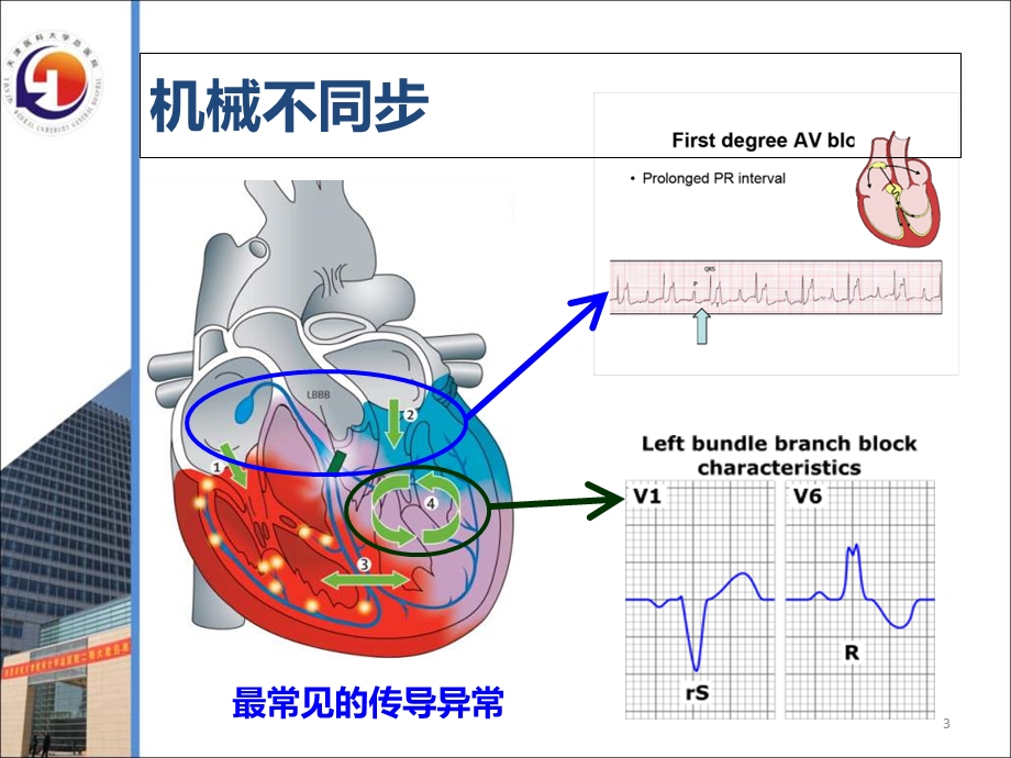 心力衰竭患者CRT治疗适应证与时机.ppt_第3页