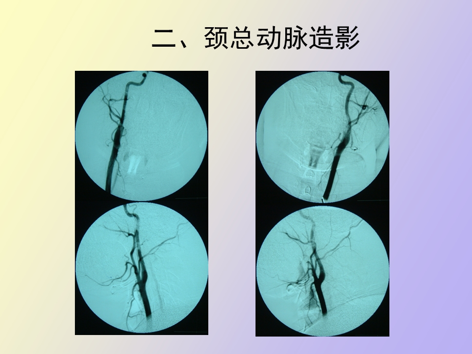 正常脑血管造影.ppt_第3页