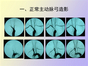 正常脑血管造影.ppt