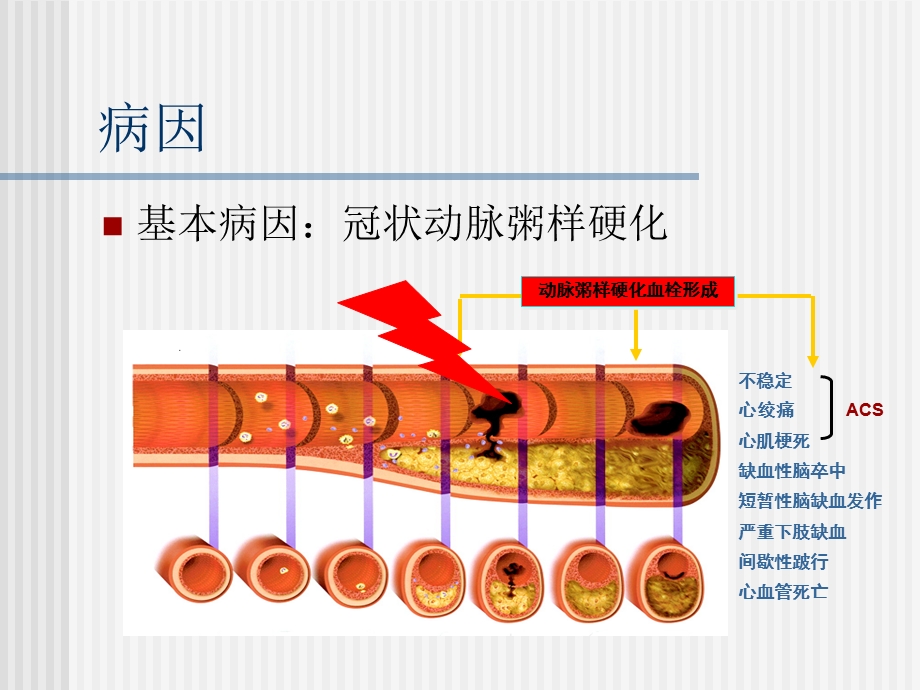 心梗疾病知识及护理ppt课件.ppt_第3页