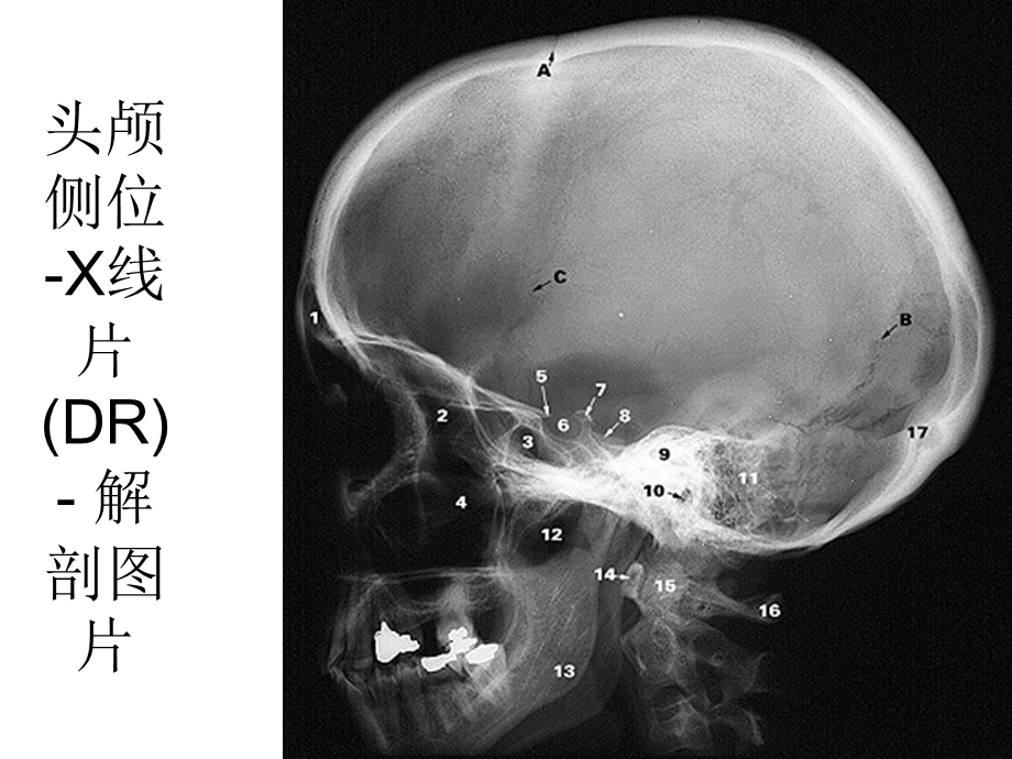 正常X线影像解剖.ppt_第2页