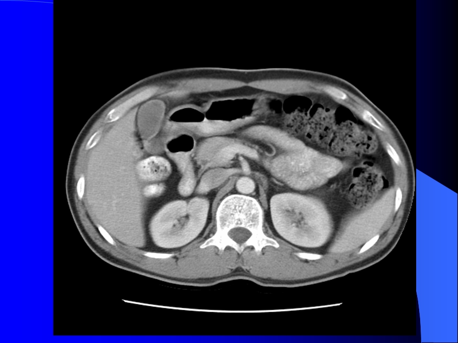 腹部CT2ppt课件.ppt_第1页