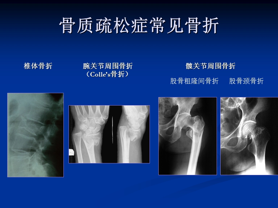 抗骨质疏松症药物治疗的选择.ppt_第3页