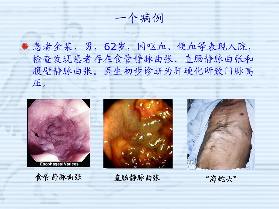 门静脉高压症病人的护理.ppt_第2页