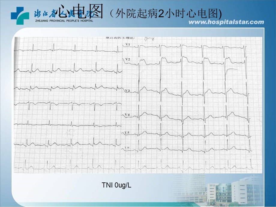 胸痛胸前导联STT改变浙江省人民医院心内科徐强.ppt_第3页