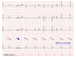 心电图常见正常和异常心电图图谱.ppt