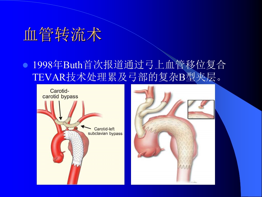 杂交技术治疗主动脉夹层.ppt_第3页