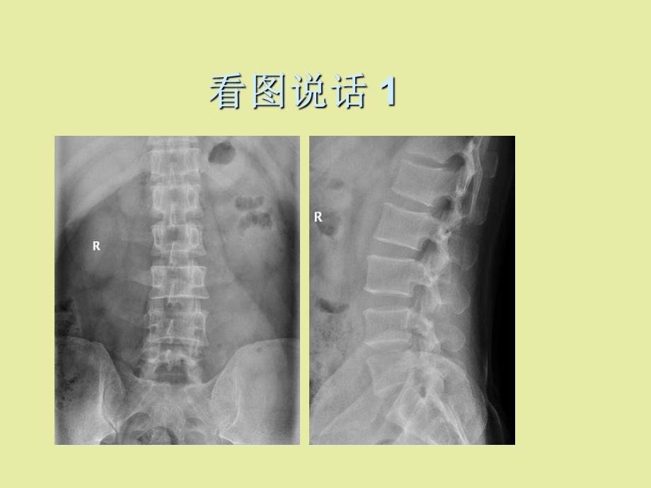 椎体疾病随访.ppt_第1页