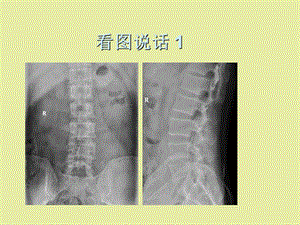 椎体疾病随访.ppt