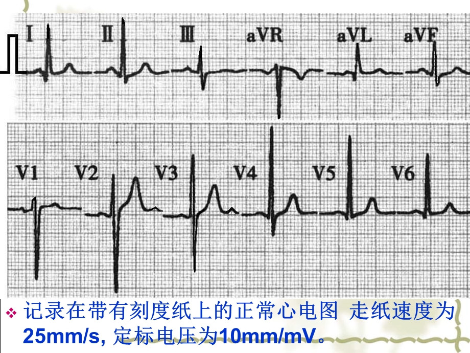 正常心电图及常见异常心电图.ppt_第3页