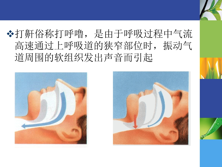 打鼾与睡眠呼吸暂停综合征.ppt_第3页