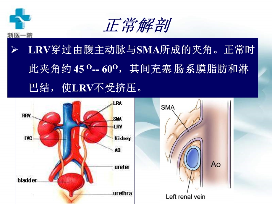 胡桃夹综合征的治疗.ppt_第3页