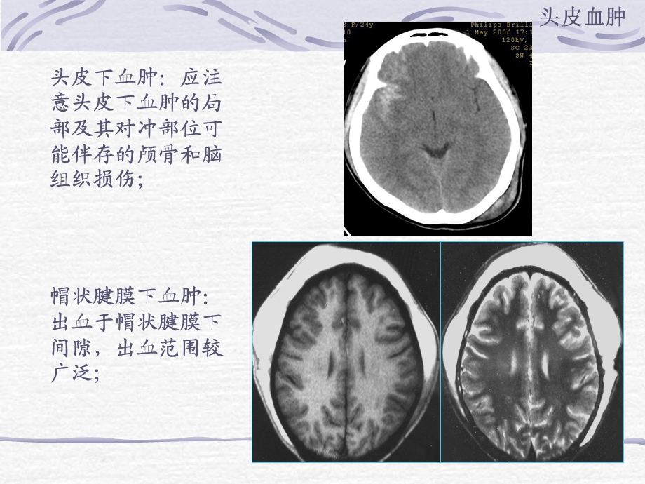 颅脑外伤CT王小宜.ppt_第3页