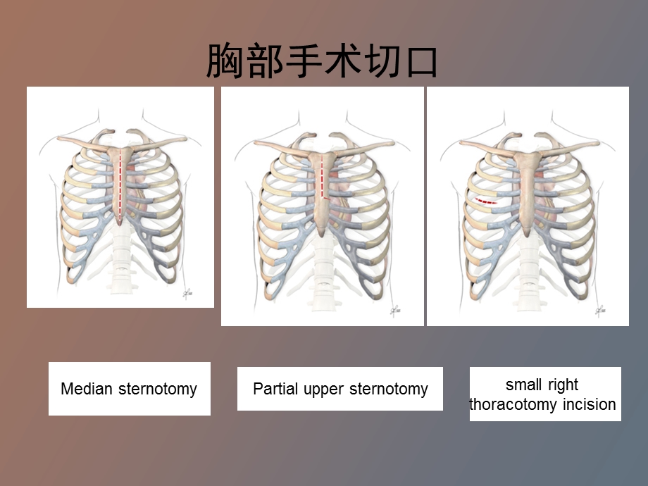 开胸术后镇痛.ppt_第2页