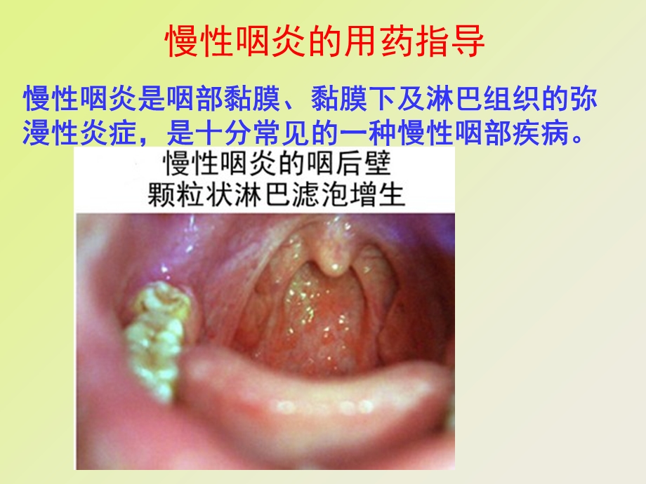 慢性咽炎的用药指导.ppt_第1页