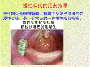 慢性咽炎的用药指导.ppt