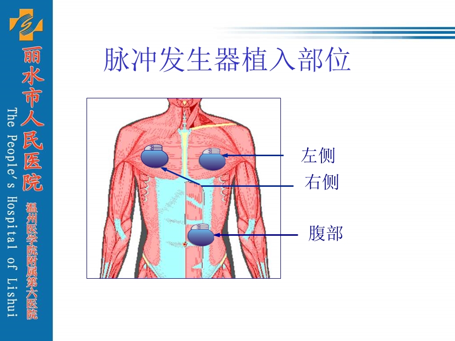 心室常规起搏电极安置和固定技巧.ppt_第3页