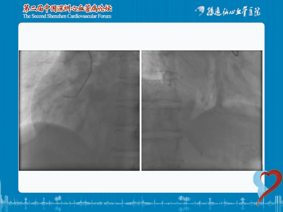 高血栓负荷的临床评估及处理策略.ppt_第3页