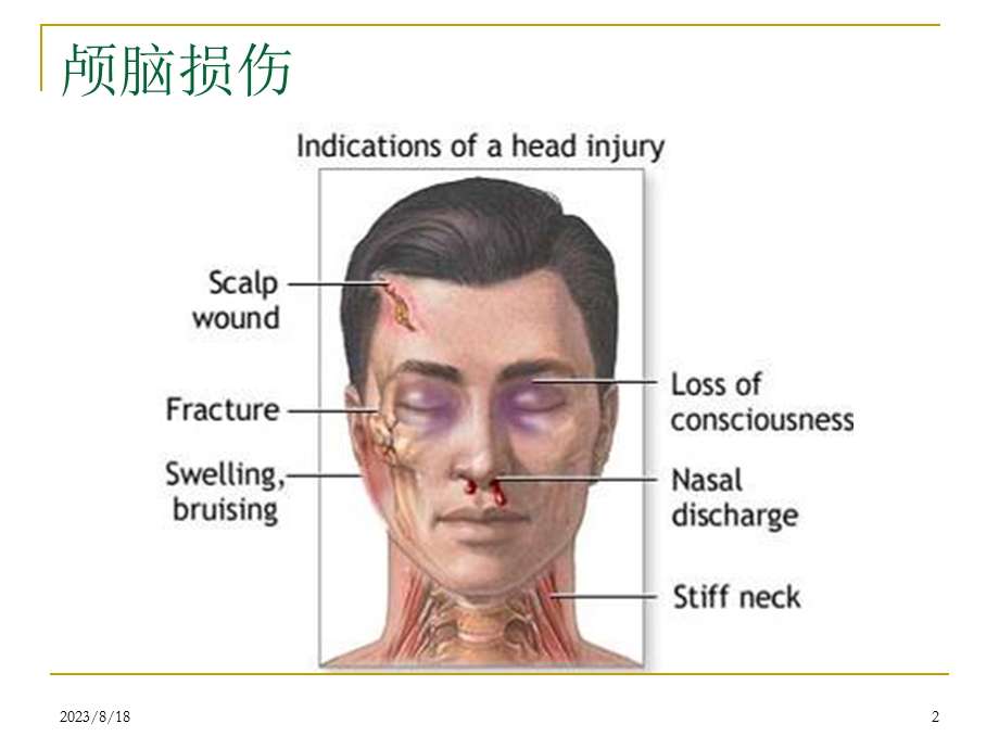 颅脑损伤多媒体.ppt_第2页